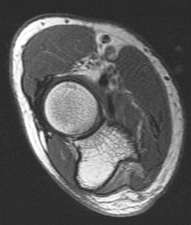 Figure 6 for case Ulnar neuritis and denervation of the flexor digitorum profundus